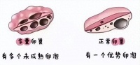 多囊卵巢综合征怀孕很难?“送子妙手”破多囊助力“好孕”降临
