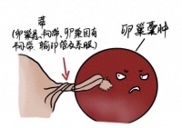 23岁孕妈孕早期突发卵巢囊肿蒂扭转!危急时刻手术保母胎平安