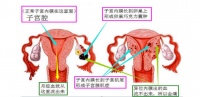 子宫内膜异位症对备孕女性有多大影响