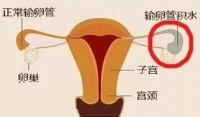 备孕中遇上输卵管积水,中医要如何调理?