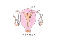 兰州天伦备孕课堂:宫腔息肉如何阻挡女性好孕?子宫息肉对女性危害有多大?