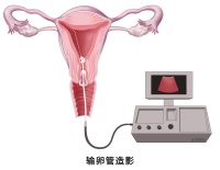久备不孕?生殖系统“侦察兵”来帮你