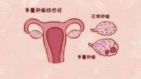 禾孕嘉丨多囊患者备孕攻略:五大策略助您好孕!