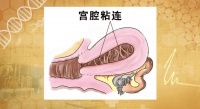 面对备孕 “拦路虎”—— 宫腔粘连,怎样绝境求生?