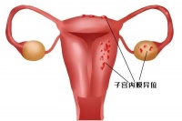 禾孕嘉丨子宫内膜异位症患者的试管之路:希望与挑战并存