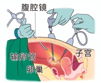 输卵管切断之后还能接上自然怀孕吗