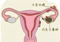 巧克力囊肿会不孕?如何改善、提升怀孕率?