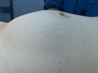 【精医技】21岁少女腹部疼痛竟是长了盆腔巨大肿块,单孔腹腔镜微创手术助其成功“拆弹”!