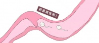 容易引起输卵管堵塞的5件事，女性可能都做过