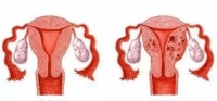 哈尔滨 腺肌症?备孕撞上腺肌症,先手术还是先备孕?
