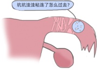 上海祝秀英医生:输卵管粘连了,还有机会自然怀孕吗?