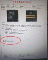 破解胰岛素抵抗，30岁多囊女子空心卵泡终成“实心”好孕！