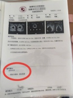 辽宁一孕妇两个月内从一胎变四胞胎，医生：系同卵四胞胎