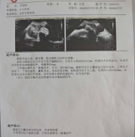 腹腔镜精准除巨瘤 守护十岁女童健康