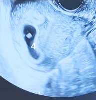 女子因备孕困难自行服用“多子丸”，一次怀上四胞胎，就医后手术减至双胎，医生提醒