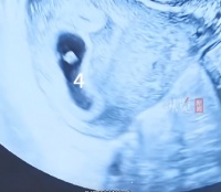 女子备孕困难自行服“多子丸”，怀上四胞胎！医生：不是“福气”而是医学风险！