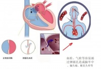备孕体检查出卵圆孔未闭，别慌！这份风险评估+可降解方案请收好