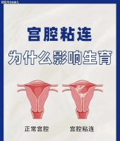 厦门三代试管中心林主任分享：宫腔粘连对女性生育有什么影响？需要注意哪些方面