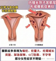 腺肌症家庭试管助孕指南：避开弯路，提高妊娠概率