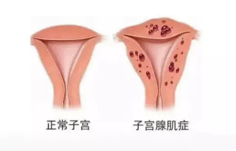 郴州唐梅艳：子宫腺肌病痛经量多、月经拖尾、备孕难，别只当痛经