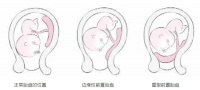 孕妈妈胎盘早剥怎么办?