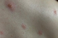 传染性强、人群普遍易感 水痘高发期如何防?