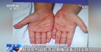 家长注意!又到手足口病高发期 小心孩子这些症状